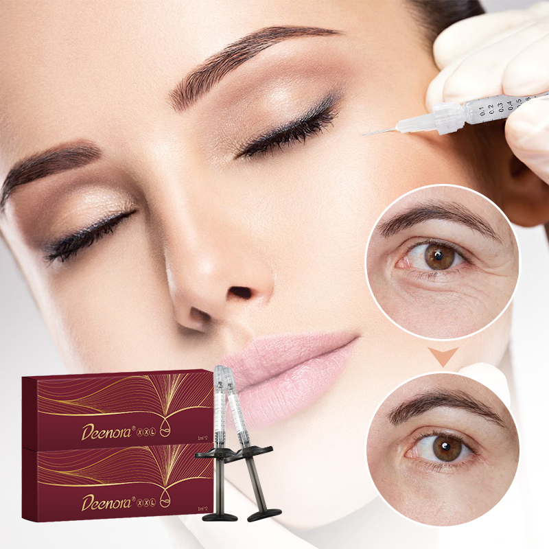 The 2nd Generation Injectable Hyaluronic Acid Filler